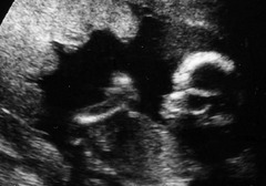 赤ちゃんのエコー写真(16週目) 5ヶ月